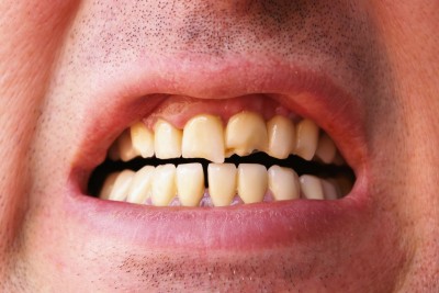 Gum Disease More Likely to Cause Strokes than Diabetes 