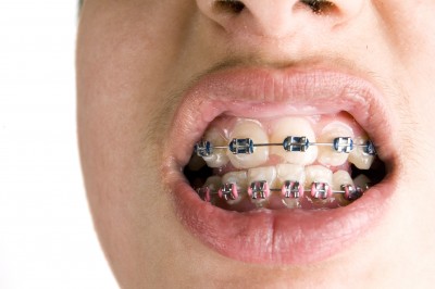 Orthodontic Problems Prevalent in Saudi Arabia 