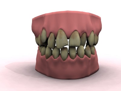 Scientists Issue MRSA Warning for Dentures 