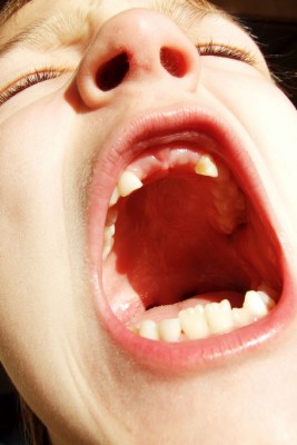 Half Of British Children Have Tooth Decay