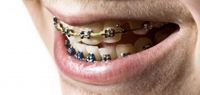Dental braces latest adult trend