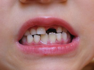 Bolton pushes for better oral health for children